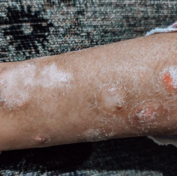 Psoriasis skin condition