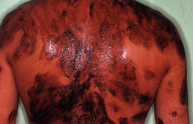 Father’s Day: Growing Up with My Father’s Psoriasis