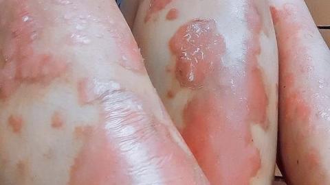 psoriasis skin condition