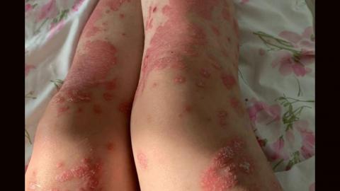psoriasis skin condition